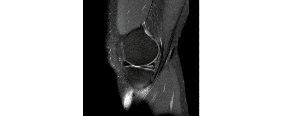 Partial-thickness ACL tear with tibial traction cysts — the subtle intrasubstance signal that changes management — Key images 2