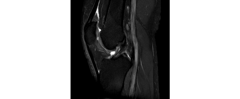 Partial-thickness ACL tear with tibial traction cysts — the subtle intrasubstance signal that changes management — Key images 3