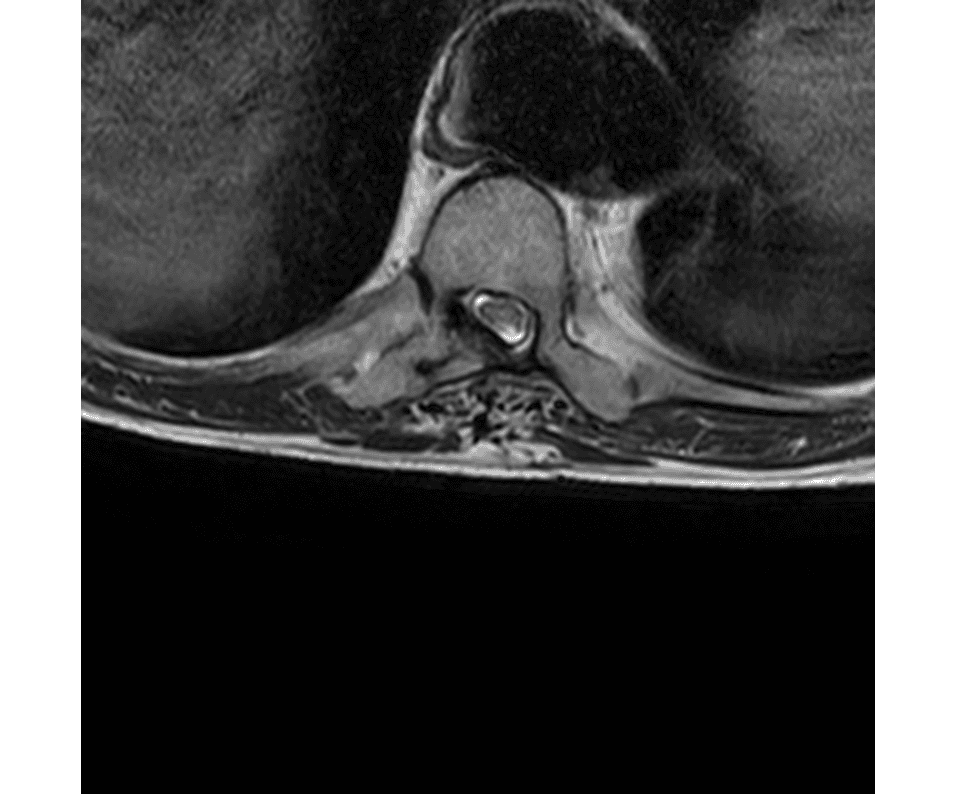 Aggressive T10 posterior-element lesion — recognising cord compression as an urgent MRI finding — Key images 2