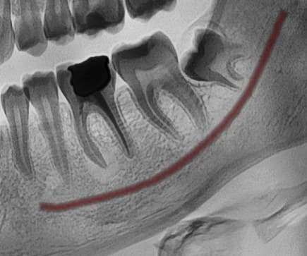 CBCT — inferior alveolar canal delineated in 3D