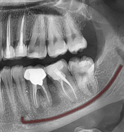 CBCT — implant site, root apex, and nerve proximity