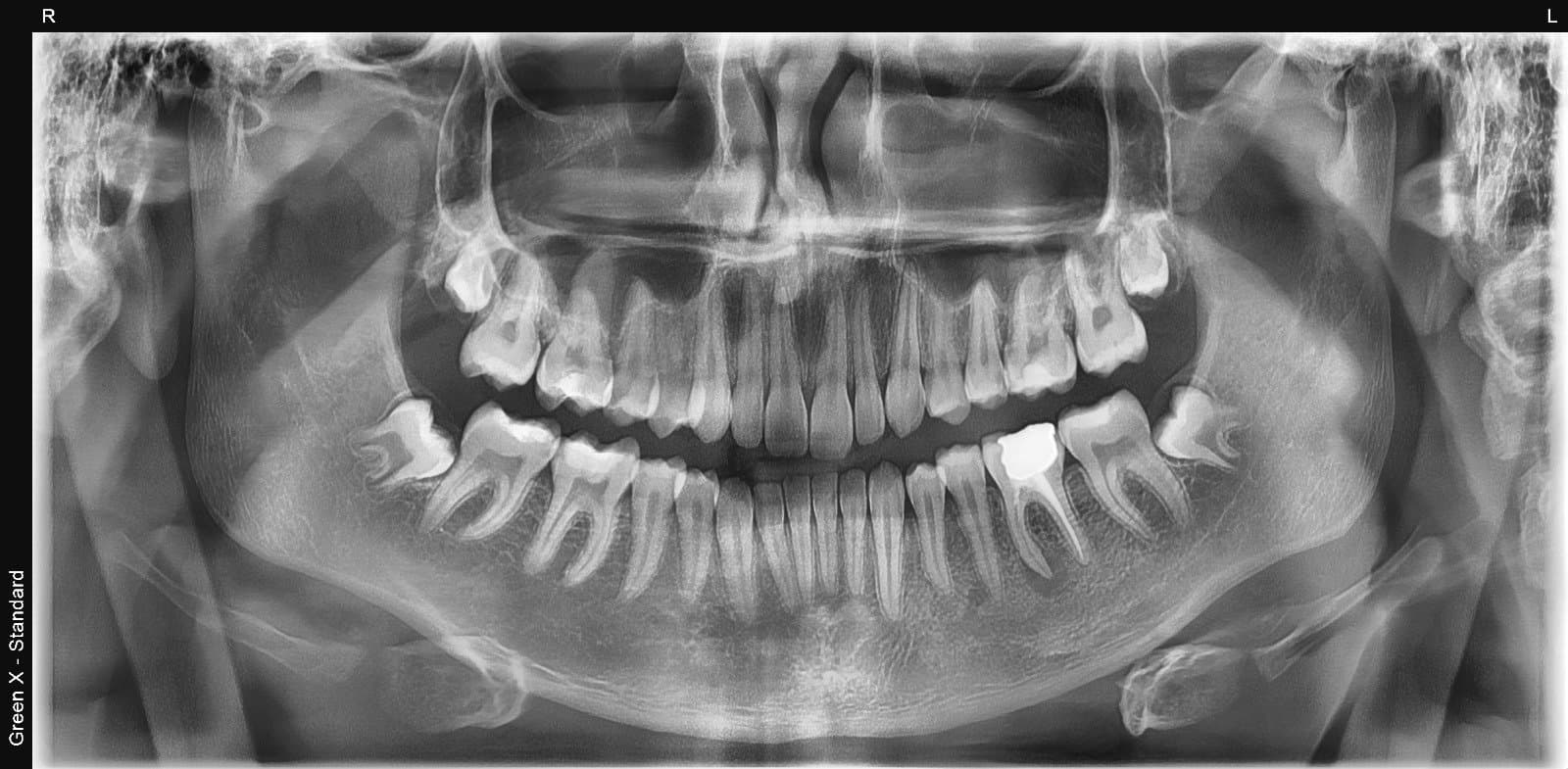Green X-12 full panoramic X-ray